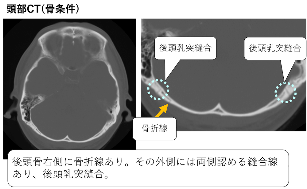 頭部CTで骨折線と紛らわしい後頭乳突縫合とは？